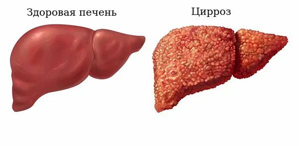 Покажи фото цирроза печени Билиарный цирроз печени: причины, симптомы и лечение в статье гепатолога Глазков