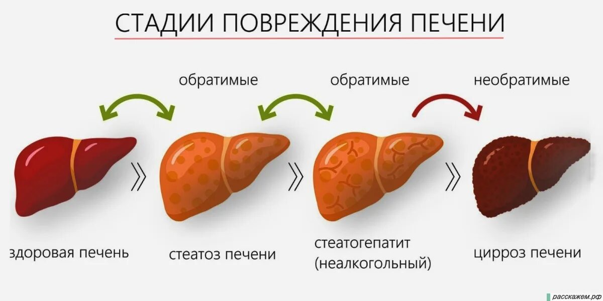 Покажи фото цирроза печени Цирроз печени 3 стадия прогноз