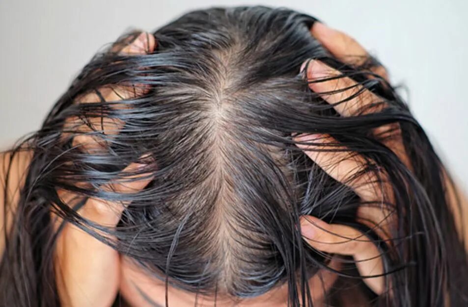 Покажи фото волос Ways to Deal with an Oily Scalp Ziering Medical