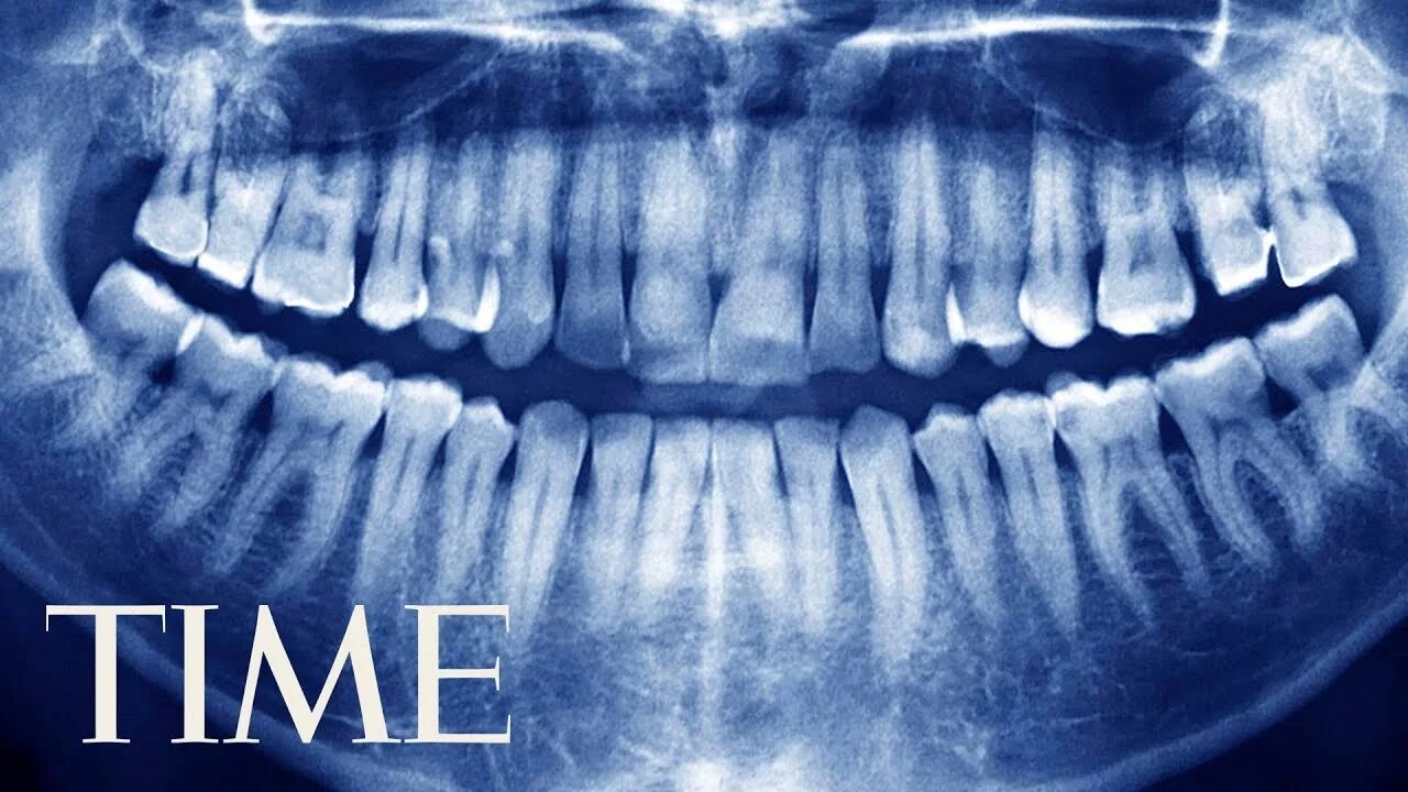 Покажи фото зубов 7-Year-Old Boy Has 526 Teeth Removed From His Mouth TIME - YouTube