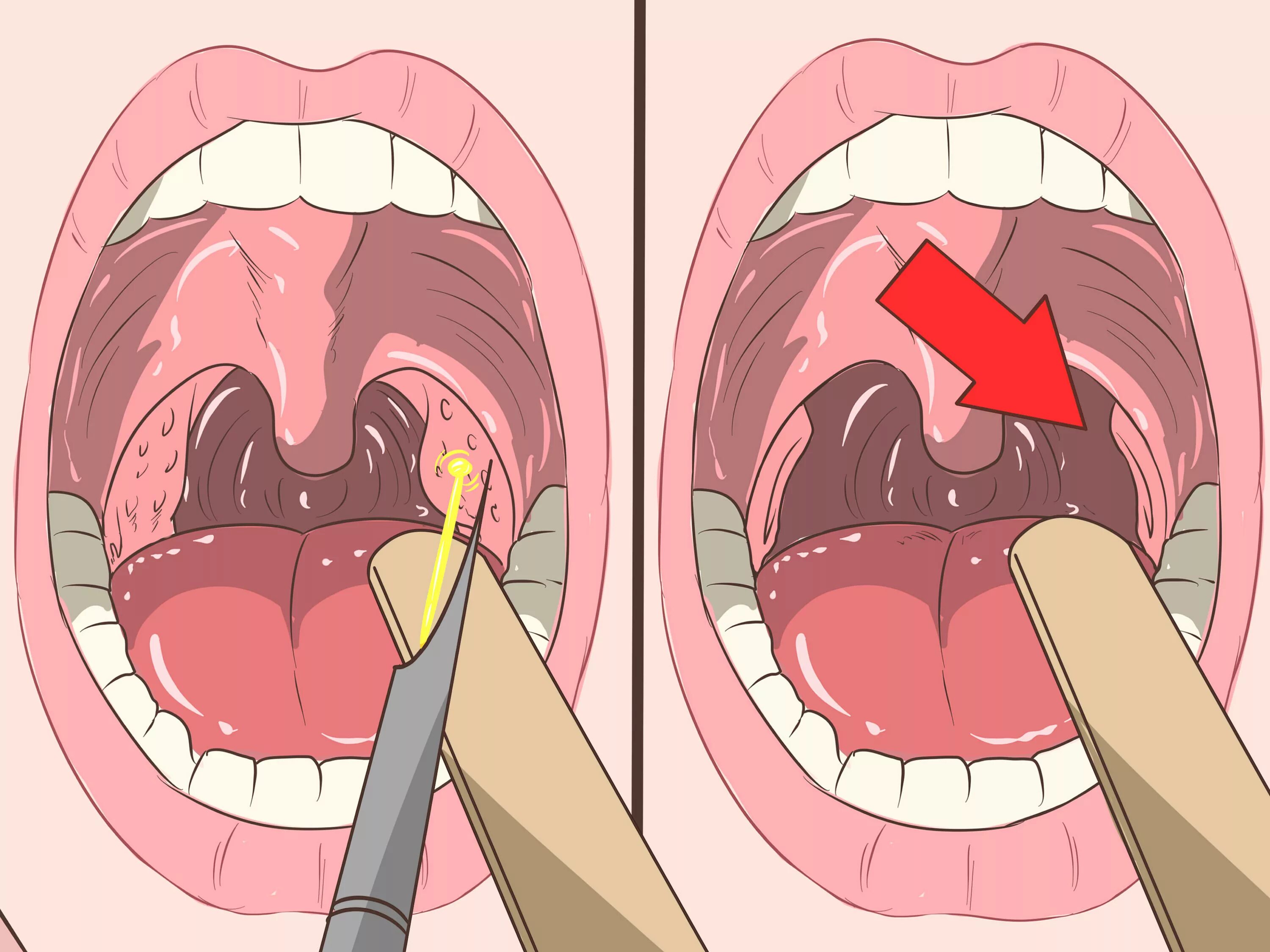 Покажи как выглядит горло 4 Ways to Remove Tonsil Stones (Tonsilloliths) - wikiHow