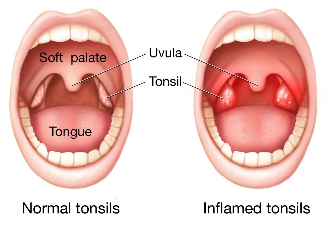 Покажи как выглядит горло Tonsillitis - Symptoms & causes - Mayo Clinic