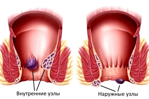 Покажи картинки как выглядит геморрой Геморроидальный тромбоз: лечение наружного и внутреннего геморроидального узла -