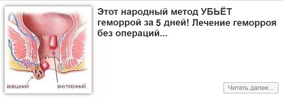 Покажи картинки как выглядит геморрой Схема лечения наружного геморроя у мужчин