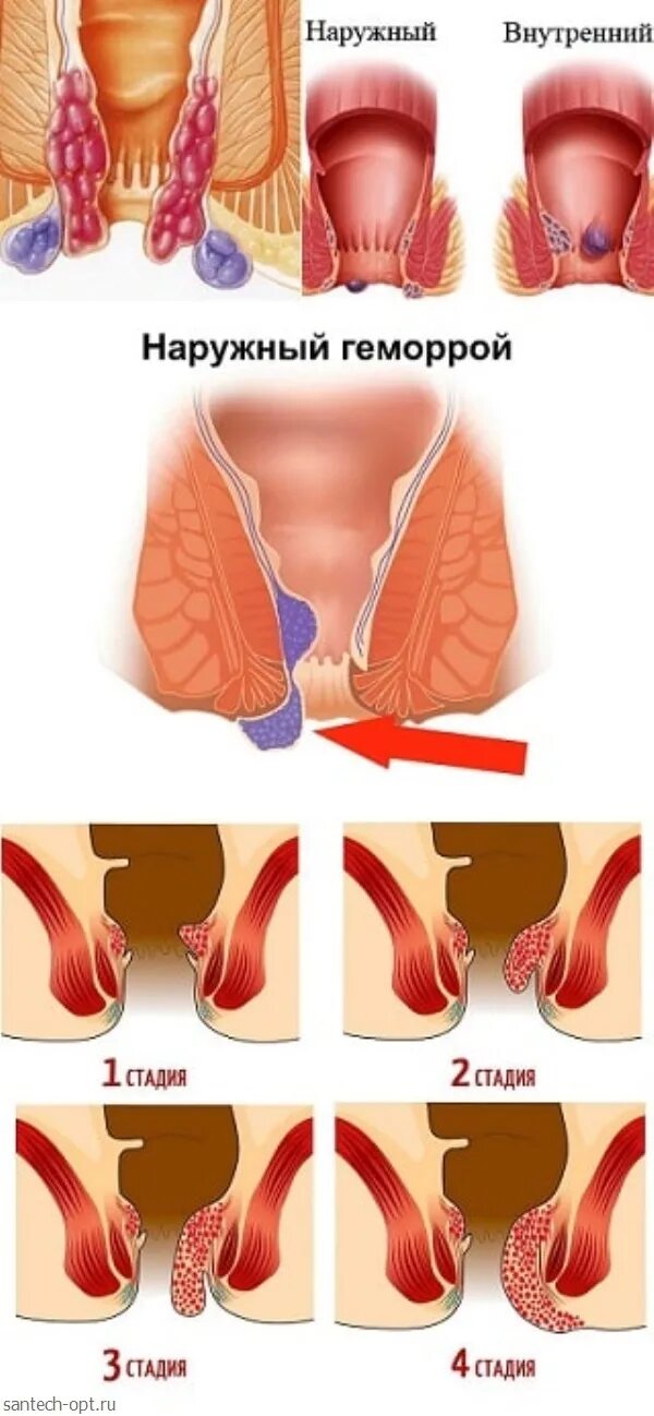 Покажи картинки как выглядит геморрой Геморрой клиническая картина