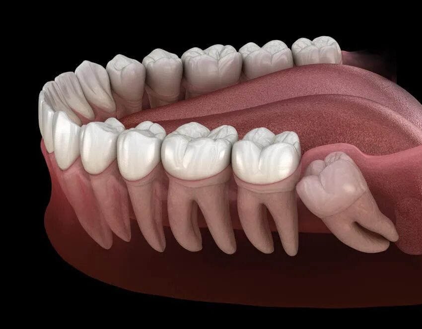 Tooth Decay Progression (Dental Caries) Dental caries, Dental, Tooth decay