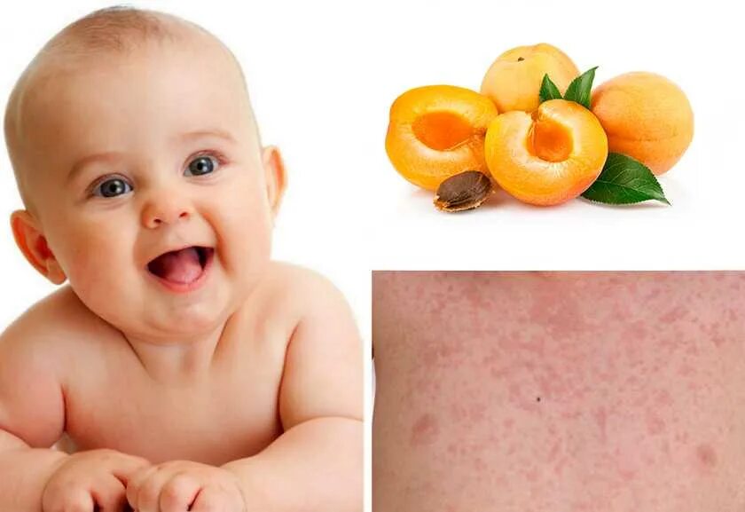 Покажите как выглядит аллергия Baby food allergy rash pics