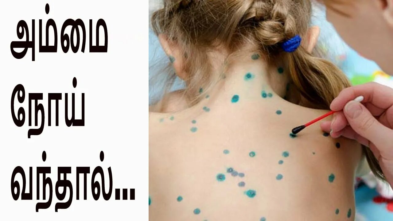 Покажите как выглядит ветрянка அம்மை நோய் வந்தால்.../Ammai Treatment/Chicken Pox Treatment - YouTube