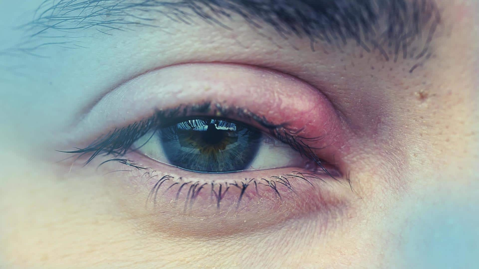 Close Up of Man Red Irritated Eyes Stock Image - Image of male, illness: 1380512