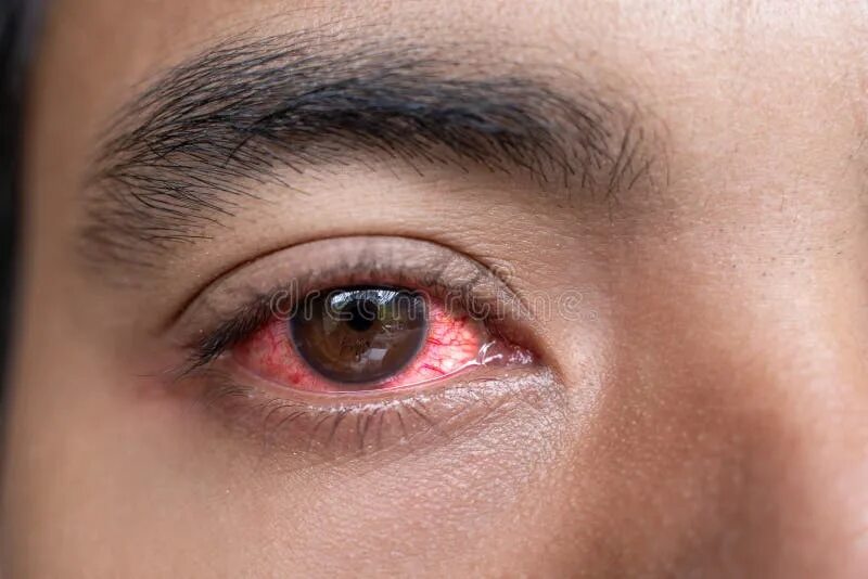 Покраснели глаза фото Close Up of Man Red Irritated Eyes Stock Image - Image of male, illness: 1380512