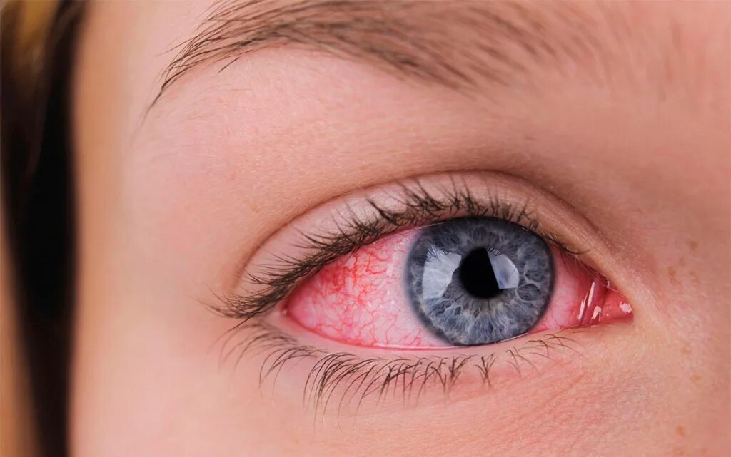 Close Up of Man Red Irritated Eyes Stock Image - Image of male, illness: 1380512