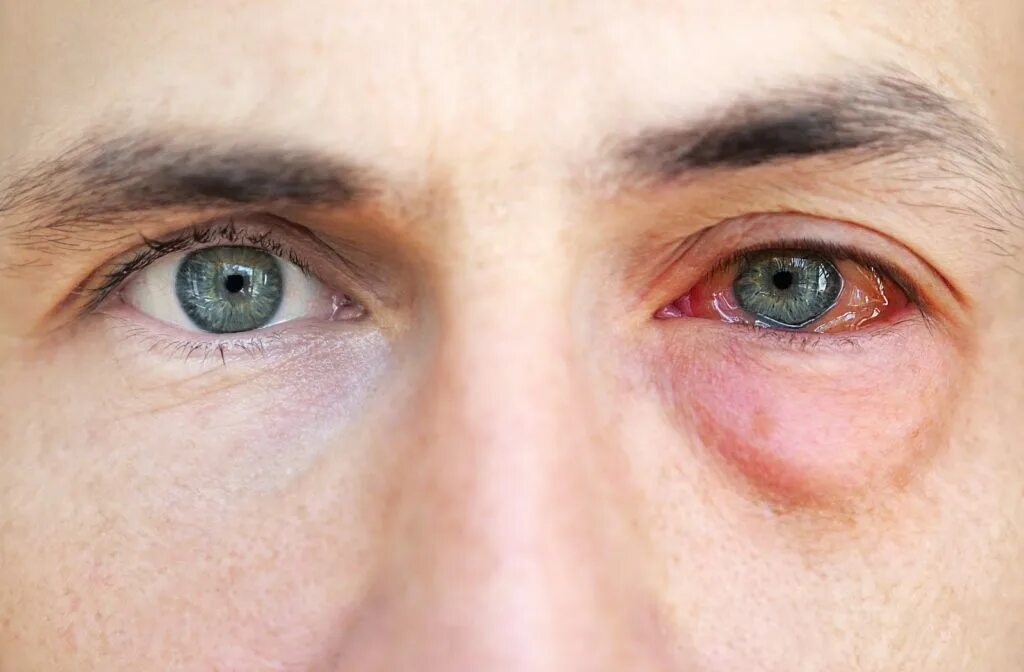 Покраснение глаз фото Can Allergic Conjunctivitis Only Be In One Eye Flash Sales bellady.by