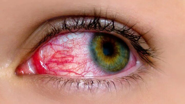 Покраснение глаз фото eye - Google Search Eye makeup, Pink eyes, Dry eyes