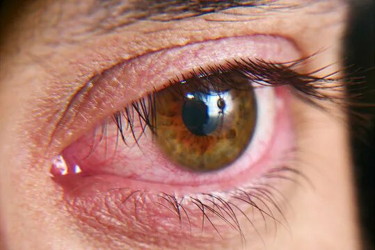 Покраснение глаз фото Eye Infection Зображення - огляд 57,398 Стокові фото, векторні зображення й віде