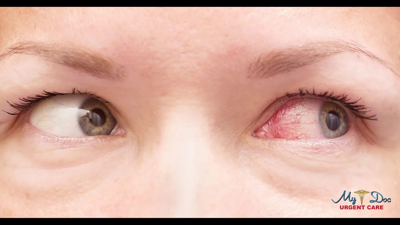 Покраснение глаз фото Urgent Care Bergen Passaic County NJ Pink Eye - YouTube