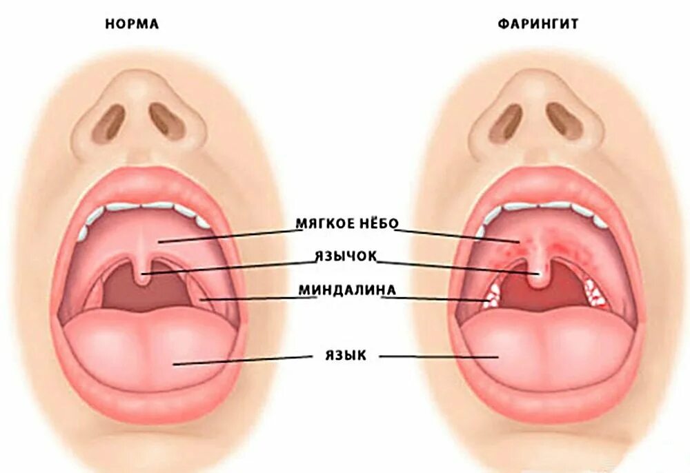 Покраснение горла фото Сколько болит горло при фарингите, сколько длится сама болезнь