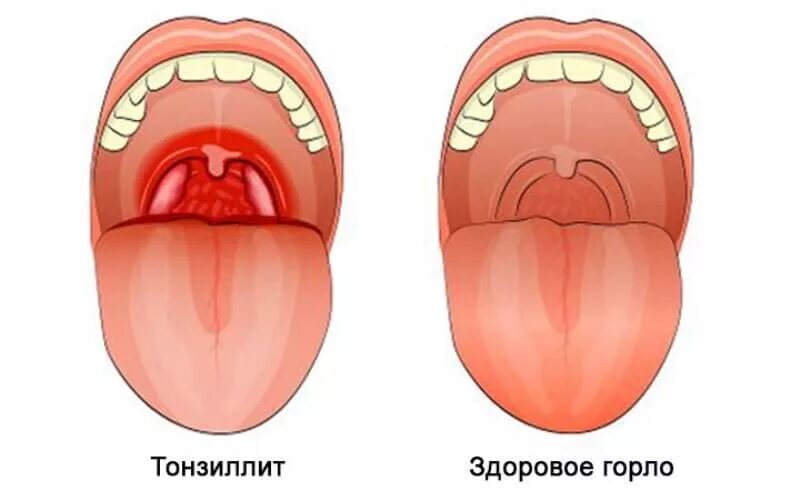 Покраснение горла фото Тонзиллит хронический и острый. Симптомы и лечение