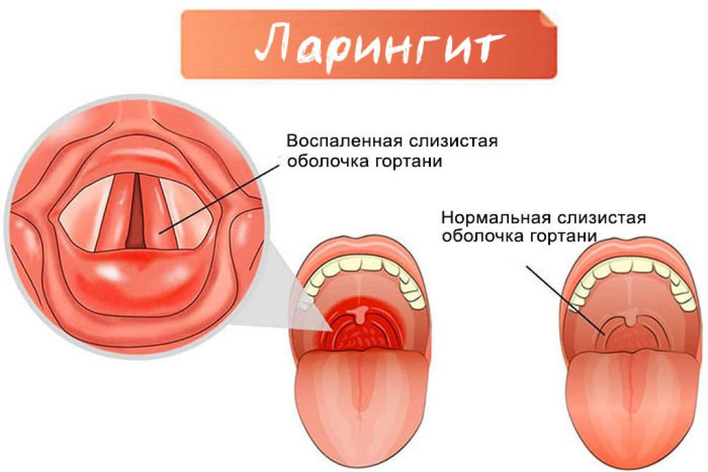 Покраснение горла фото Ларингит: симптомы, диагностика и методы лечения - Ваше здоровье