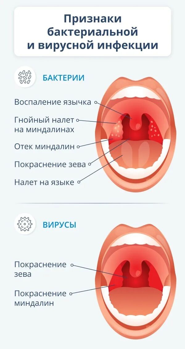 Покраснение горла фото Как вылечить заболевания, при которых чешется горло изнутри и кашель