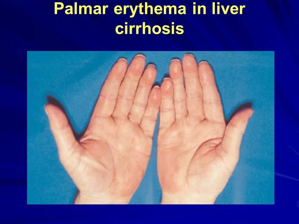 Покраснение ладоней при циррозе печени фото LIVER CIRRHOSIS LIVER CIRRHOSIS. THE ANATOMY OF THE PORTAL VENOUS SYSTEM. - ppt 