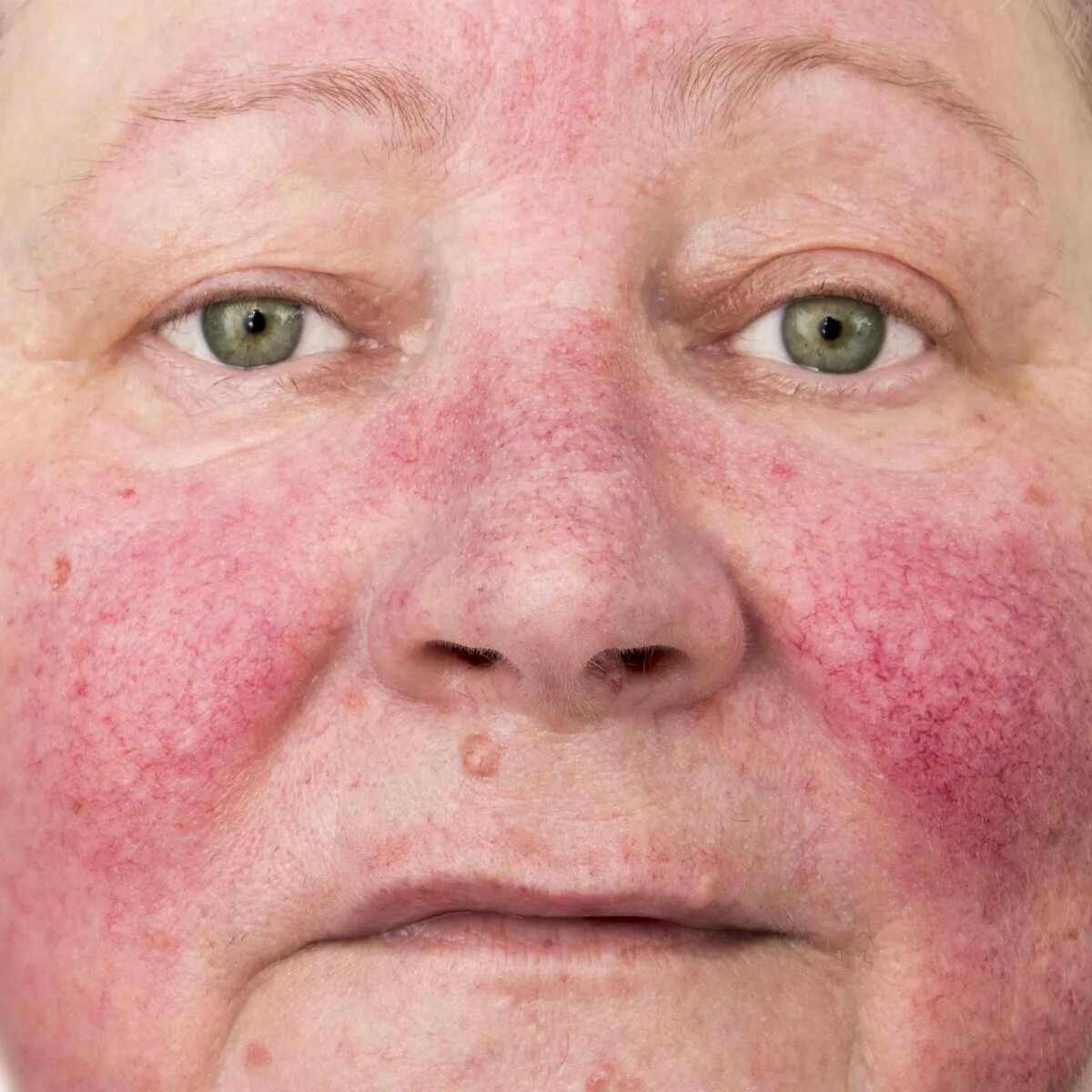 Покраснение на лице в виде бабочки фото Global Look at Data Indicates Which Subtypes of Rosacea Are Most Prevalent