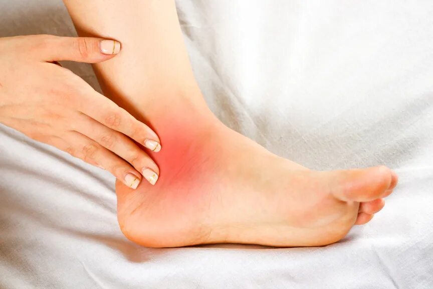 Покраснение на ноге выше щиколотки фото Common Risk Factors for Tarsal Tunnel Syndrome The Physical Therapy Advisor