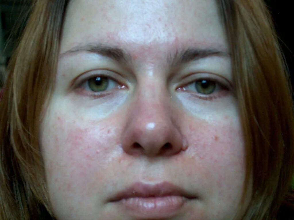 Покраснение носа и между бровей на фото Seb Derm or Rosacea?