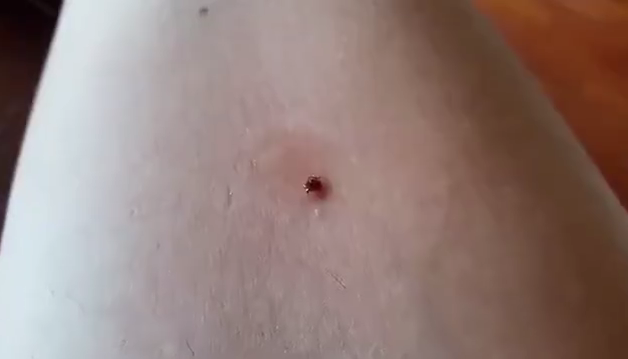 Покраснение после клеща у человека фото Watch this woman get a gross tick out of her arm. but DON’T try this at home The