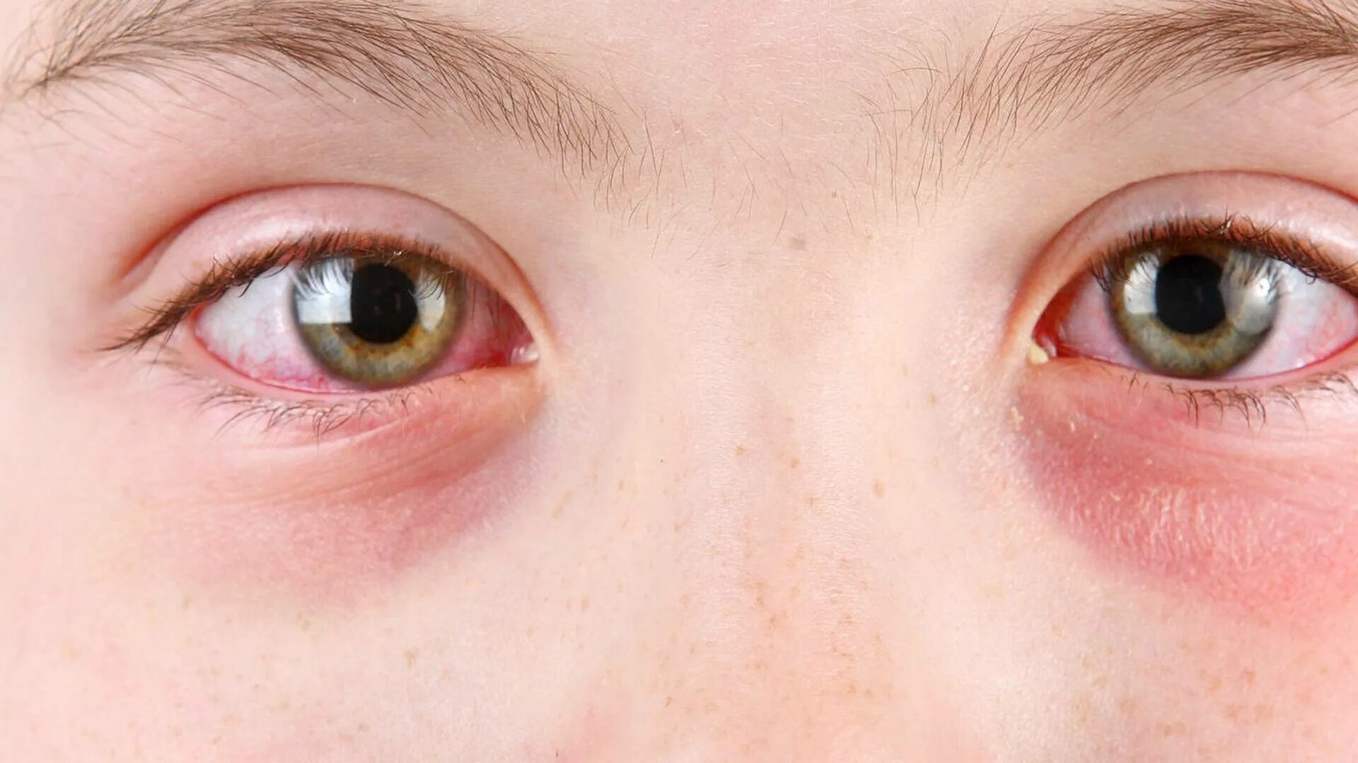 Покраснение век фото Mayo Clinic Minute: What is pink eye? - Mayo Clinic News Network