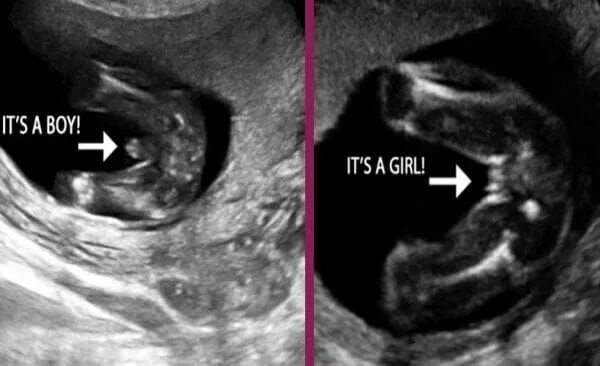 Пол на 12 недели фото I'm pregnet Baby gender ultrasound, Gender reveal ultrasound, Ultrasound gender