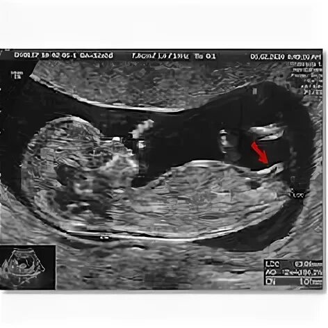 Пол на 12 недели фото 28 Yusra ideas ultrasound, ultrasound sonography, sonography