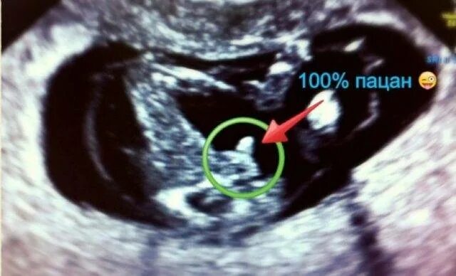 Пол на 12 недели фото 12 недель беременности пол ребенка