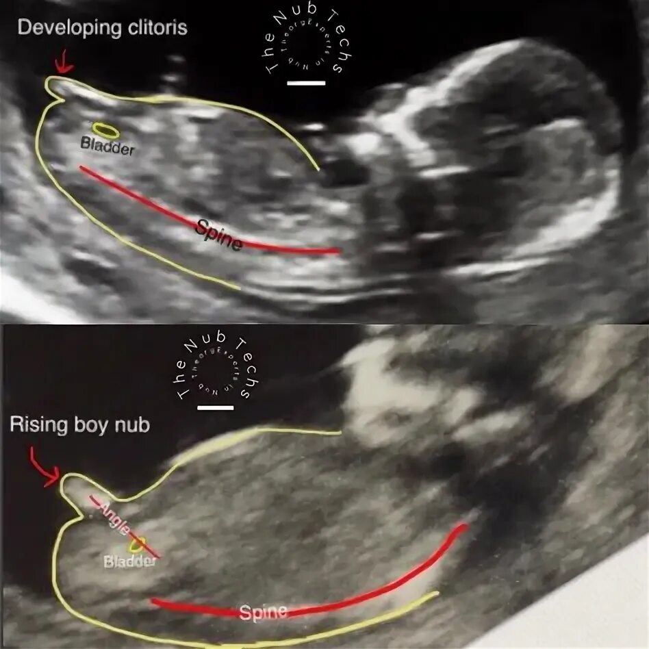 Пол на 12 недели фото 11 Ultrasound gender ideas in 2021 ultrasound gender, ultrasound, gender predict