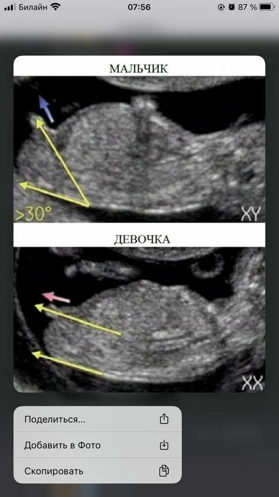 Пол ребенка 20 недель фото Поглядим пол? - 6 ответов форум Babyblog