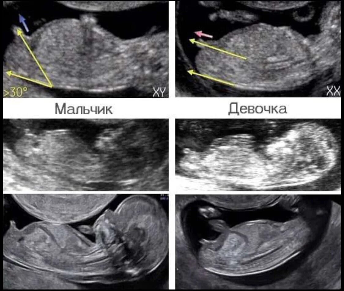 Пол ребенка 20 недель фото Узи пола