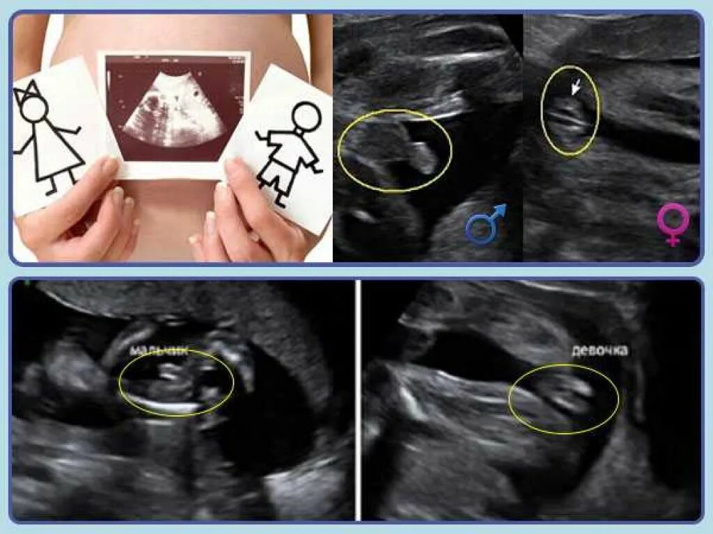 Пол ребенка 20 недель фото Узи пола