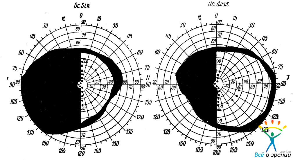 Поле зрения фото Топическая диагностика гомонимной гемианопсии