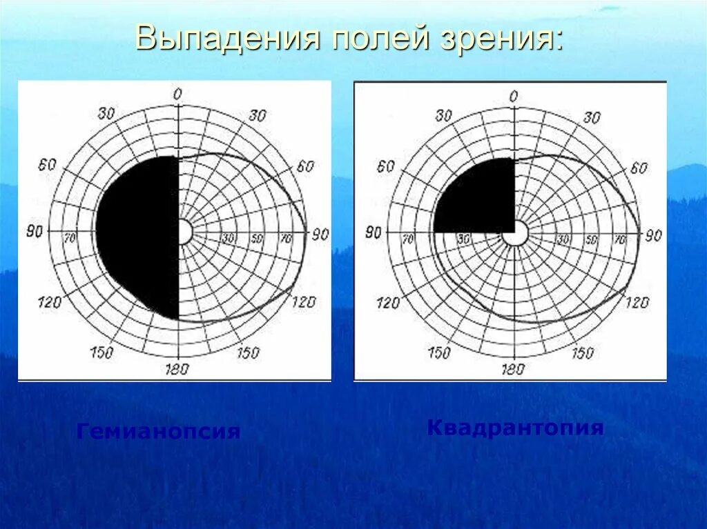 Что значит близорукость на одном из меридианов? - энциклопедия Ochkov.net