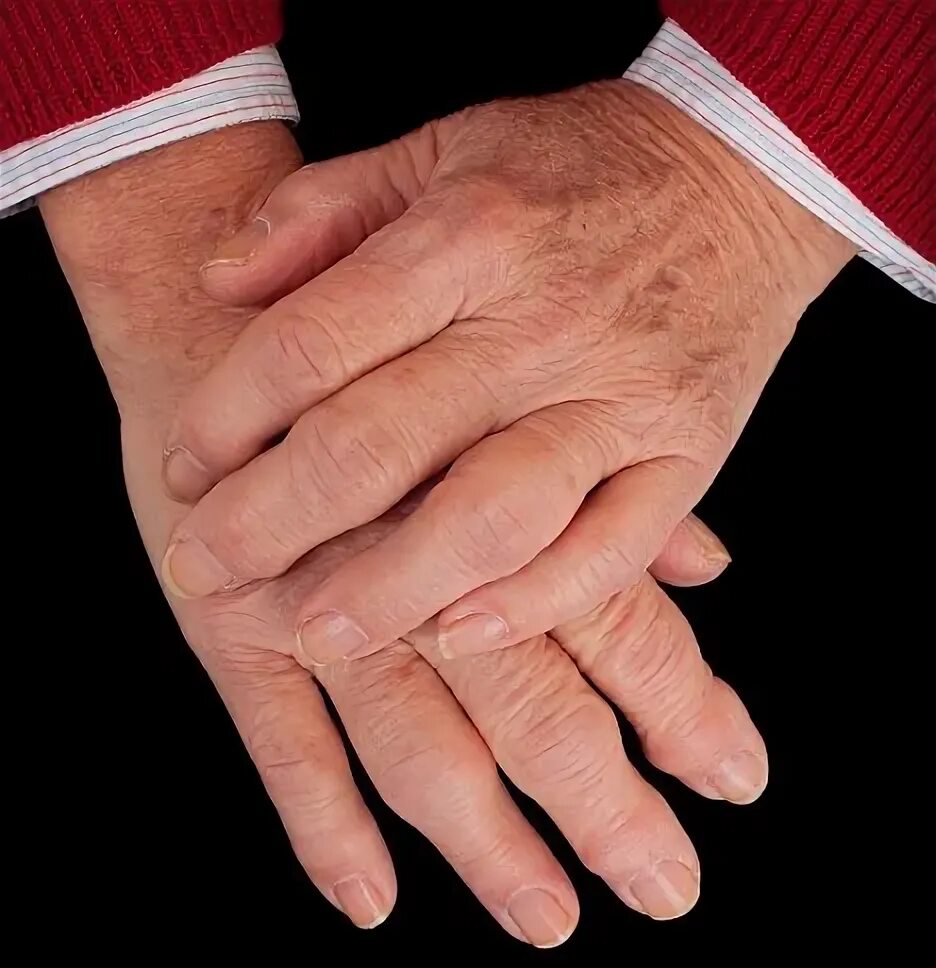 Полиартрит кистей рук симптомы лечение и фото NHS given go-ahead to prescribe new drug which eases agony of rheumatoid arthrit