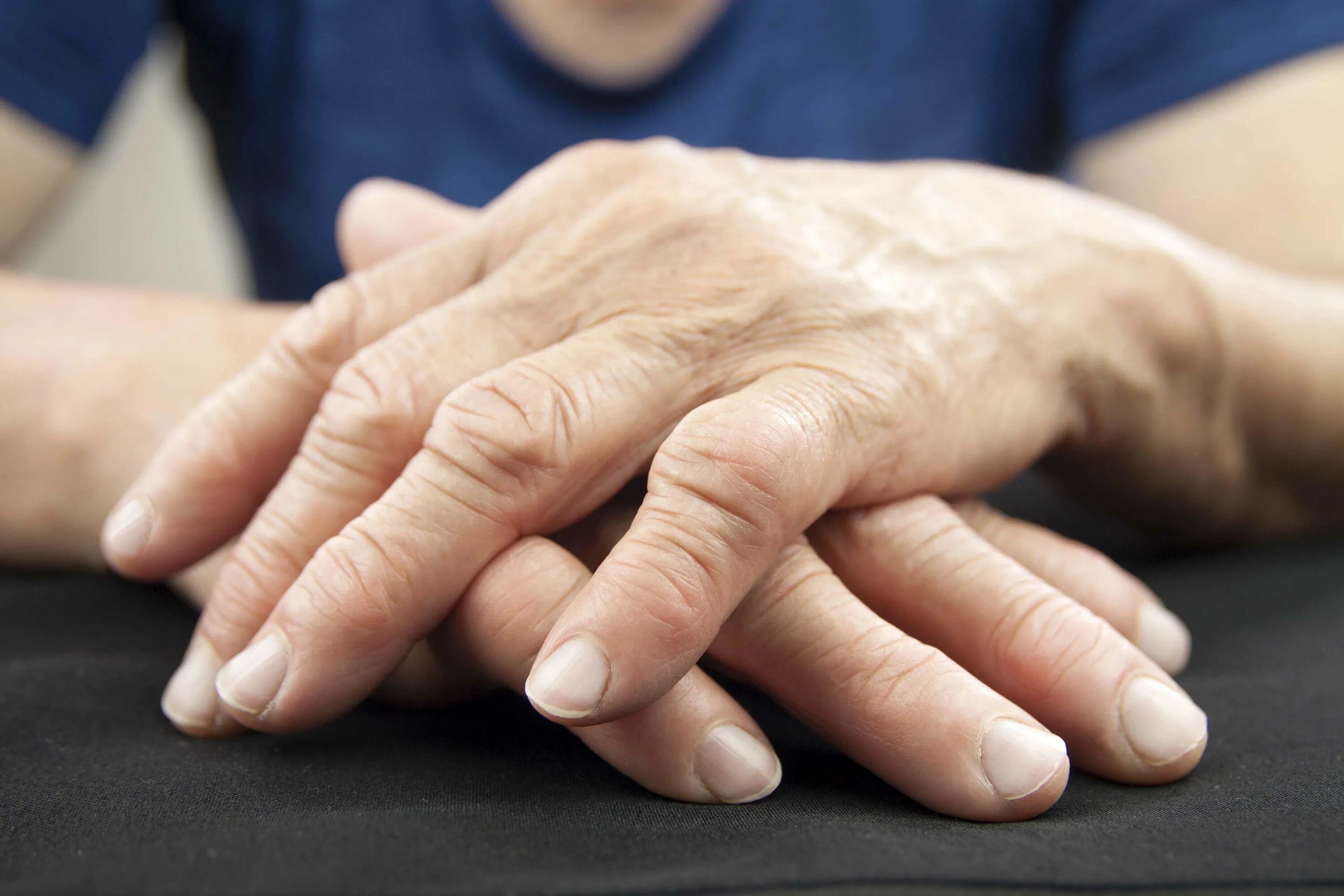 Полиартрит кистей рук симптомы лечение и фото Study finds associations between rheumatoid arthritis, other diseases before and