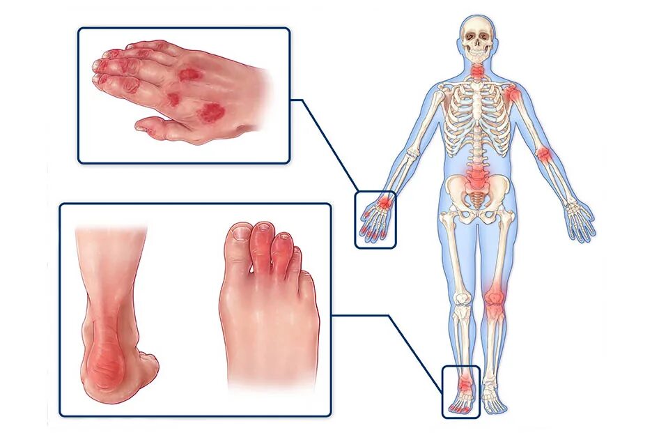 Полиартрит ног симптомы и лечение фото Псориатический артрит - диагностика и лечение по доступным ценам в Челябинске