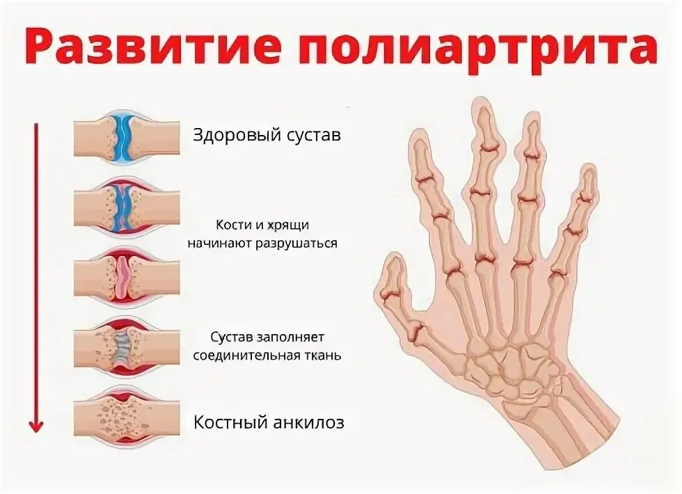 Полиартрит симптомы у мужчин и лечение фото Полиартрит - описание, цены, прием в Центре остеопатии