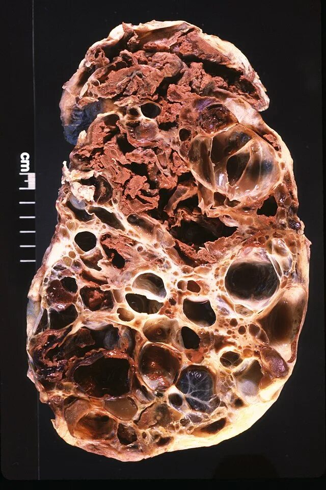 Поликистоз печени фото File:Adult Polycystic Kidney.jpg - Wikipedia