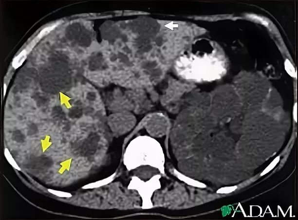 Поликистоз печени фото Kidney and liver cysts - CT scan: MedlinePlus Medical Encyclopedia Image