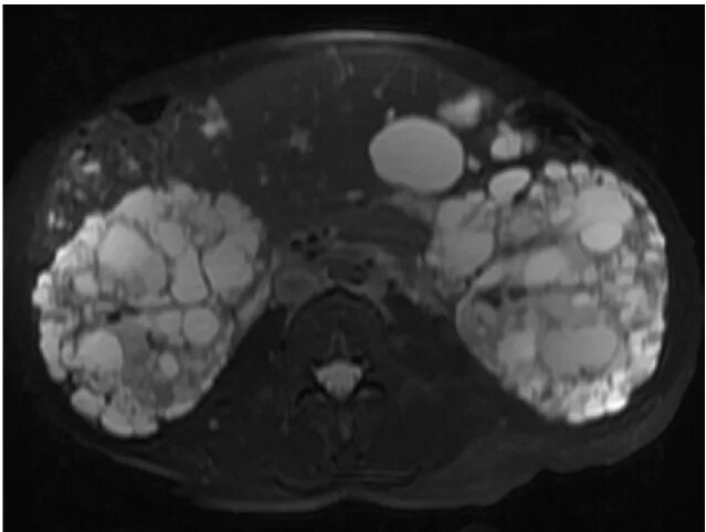 Поликистоз печени фото T2 phase MRI of the abdomen and pelvis of a patient affected by... Download Scie