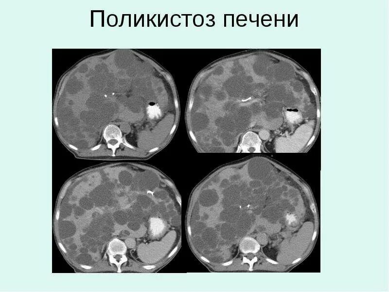 Поликистоз печени фото Очаговые образования печени - скачать презентацию