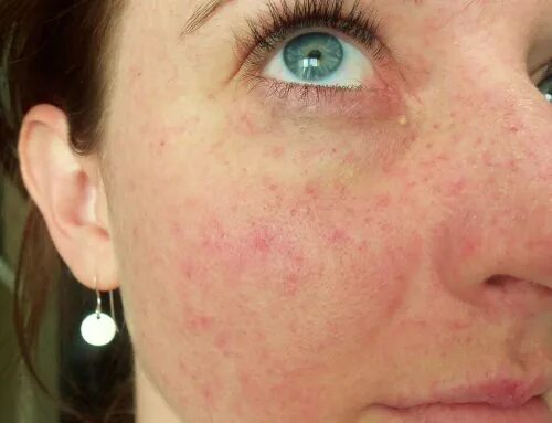 Полиморфная сыпь фото Little Red Dots Around Eyes After Throwing Up - Release Date Price Reviews