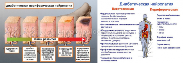 Полинейропатия нижних конечностей фото Причины нейропатии нижних конечностей у женщин