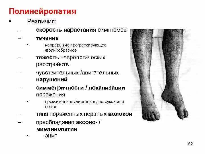 Полинейропатия нижних конечностей симптомы фото Картинки НЕЙРОПАТИЯ СТЕПЕНИ