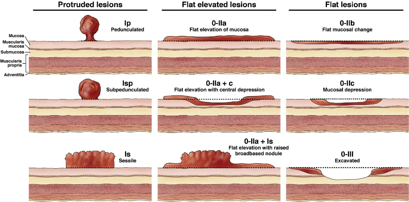 Полип как выглядит фото Figure 1 from Colorectal endoscopic mucosal resection (EMR). Semantic Scholar